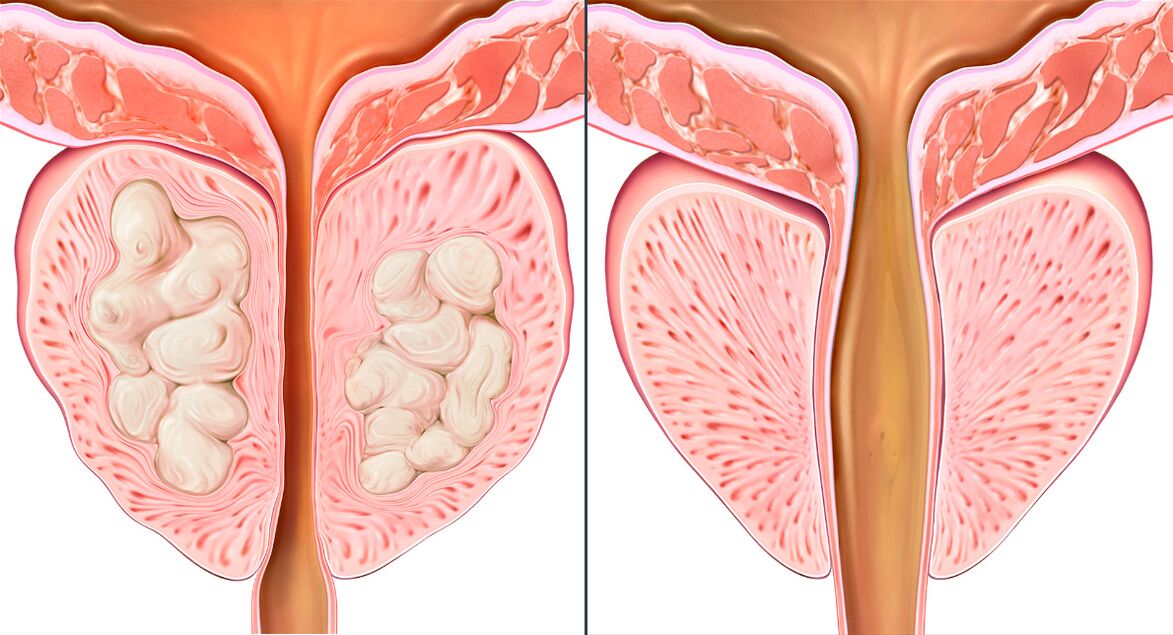 Etapas del curso del tratamiento de la prostatitis con Prostalix.